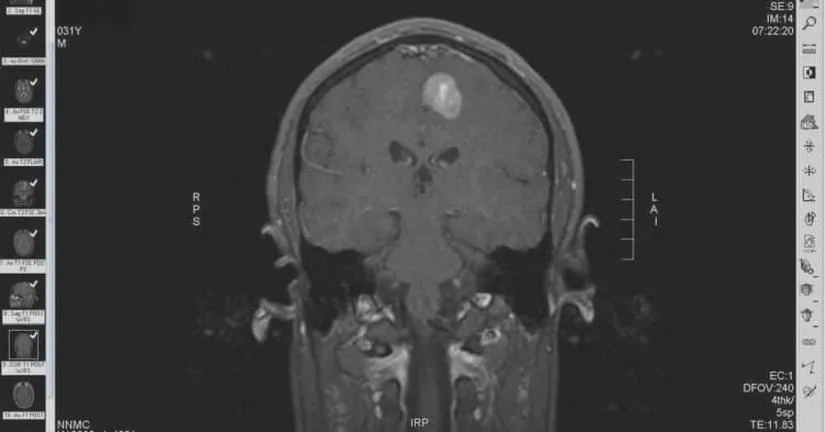 Diagnostyka guzów mózgu